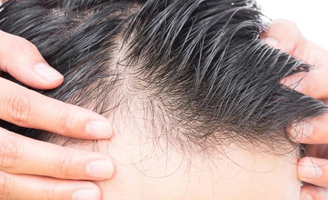 مهم ترین علت ریزش مو در مردان